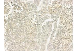ABIN6257413 and ABIN6275351 at 1/100 staining human lung squamous cell carcinoma by IHC-P. (PEX7 抗体  (C-Term))