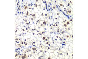 Immunohistochemistry of paraffin-embedded human kidney cancer using GTF2F2 antibody. (GTF2F2 抗体)