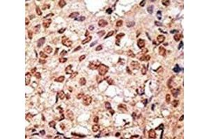 IHC analysis of FFPE human breast carcinoma stained with the SIGLEC7 antibody (SIGLEC7 抗体  (AA 1-30))