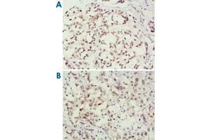 Immunohistochemical analysis of paraffin-embedded human breast cancer (A) and lung cancer (B) tissues, showing nuclear localization using MSH2 monoclonal antibody, clone 3A2B8C  with DAB staining. (MSH2 抗体)