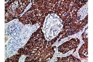 Immunohistochemical analysis of paraffin-embedded Human-lung-cancer, antibody was diluted at 1:100 (EPH Receptor B3 抗体  (AA 650-700))
