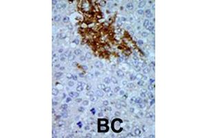 Formalin-fixed and paraffin-embedded human cancer tissue reacted with the primary antibody, which was peroxidase-conjugated to the secondary antibody, followed by AEC staining. (PNCK 抗体  (C-Term))