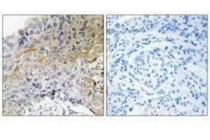 Immunohistochemical analysis of paraffin-embedded human breast carcinoma tissue using p130 Cas (Ab-410) antibody. (BCAR1 抗体  (Tyr410))