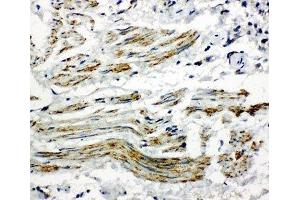 IHC-P: Caveolin-2 antibody testing of human lung cancer tissue (Caveolin 2 抗体  (AA 1-17))