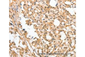 Immunohistochemistry of Human cervical cancer using APTX Polyclonal Antibody at dilution of 1:50 (Aprataxin 抗体)