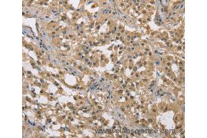 Immunohistochemistry of Human liver cancer using DACH2 Polyclonal Antibody at dilution of 1:40 (DACH2 抗体)