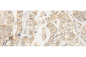 Immunohistochemistry of paraffin-embedded Human gastric cancer tissue using EIF2S2 Polyclonal Antibody at dilution of 1:35(x200)