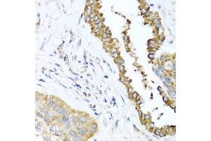 Immunohistochemistry of paraffin-embedded human lung cancer using DFNA5 antibody at dilution of 1:100 (x40 lens). (DFNA5 抗体)