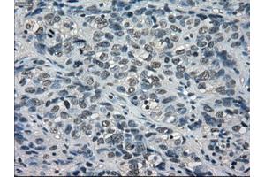 Immunohistochemical staining of paraffin-embedded Carcinoma of thyroid tissue using anti-BUB1Bmouse monoclonal antibody. (BUB1B 抗体)