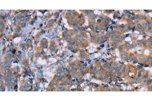 Immunohistochemistry of paraffin-embedded Human breast cancer using PON1 Polyclonal Antibody at dilution of 1:40 (PON1 抗体)