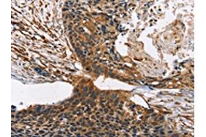 The image on the left is immunohistochemistry of paraffin-embedded Human esophagus cancer tissue using ABIN7190317(CNGA1 Antibody) at dilution 1/40, on the right is treated with synthetic peptide. (CNGA1 抗体)