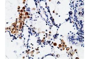 Immunohistochemical staining of paraffin-embedded Adenocarcinoma of Human breast tissue using anti-CD80 mouse monoclonal antibody. (CD80 抗体)