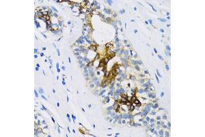 Immunohistochemistry of paraffin-embedded Human breast using PTCH1 antibody (ABIN1682368, ABIN1682367, ABIN3015342, ABIN3015343 and ABIN6213997) at dilution of 1:100 (40x lens). (Patched 1 抗体  (AA 1214-1312))