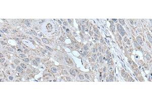 Immunohistochemistry of paraffin-embedded Human esophagus cancer tissue using SCNN1G Polyclonal Antibody at dilution of 1:40(x200) (SCNN1G 抗体)