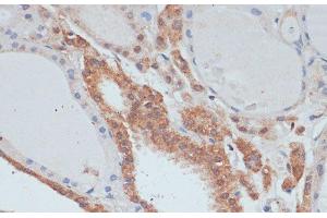 Immunohistochemistry of paraffin-embedded Human thyroid cancer using MYCBP Polyclonal Antibody at dilution of 1:100 (40x lens).