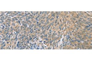 Immunohistochemistry of paraffin-embedded Human cervical cancer tissue using ZHX3 Polyclonal Antibody at dilution of 1:100(x200) (ZHX3 抗体)