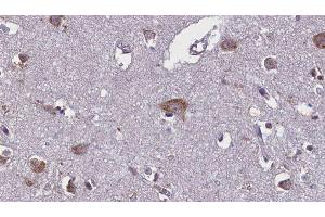 ABIN6275754 at 1/100 staining Human brain cancer tissue by IHC-P. (GNE 抗体)