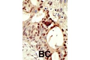 Formalin-fixed and paraffin-embedded human cancer tissue reacted with the primary antibody, which was peroxidase-conjugated to the secondary antibody, followed by DAB staining. (DNMT3L 抗体  (C-Term))