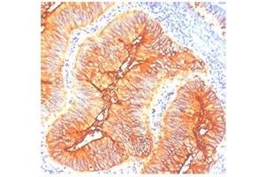 IHC staining of human colon cancer with TAG-72 antibody (TAG-72 抗体)
