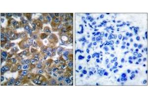 Immunohistochemistry analysis of paraffin-embedded human breast carcinoma tissue, using Keratin 15 Antibody. (KRT15 抗体  (AA 1-50))
