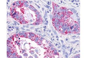 Anti-MRGPRX3 / MRGX3 antibody IHC of human Lung, Adenocarcinoma. (MRGPRX3 抗体  (Extracellular Domain))