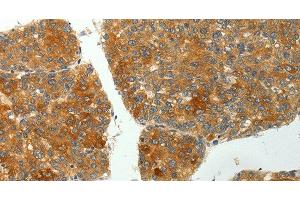 Immunohistochemistry of paraffin-embedded Human liver cancer using SH-PTP1 Polyclonal Antibody at dilution of 1:35 (SHP1 抗体)