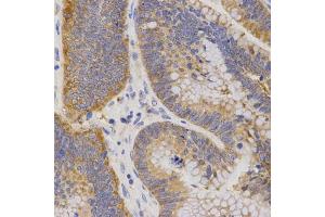 Immunohistochemistry of paraffin-embedded human rectal cancer using P2RY11 antibody (ABIN5971564) at dilution of 1/200 (40x lens). (P2RY11 抗体)