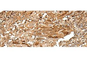 Immunohistochemistry of paraffin-embedded Human cervical cancer tissue using PIEZO2 Polyclonal Antibody at dilution of 1:55(x200) (PIEZO2 抗体)
