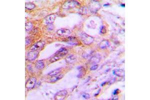Immunohistochemical analysis of S6K1 staining in human lung cancer formalin fixed paraffin embedded tissue section.