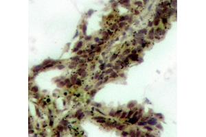 Immunohistochemistry (IHC) image for anti-V-Akt Murine Thymoma Viral Oncogene Homolog 1 (AKT1) (pThr308) antibody (ABIN3020075) (AKT1 抗体  (pThr308))