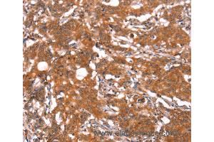 Immunohistochemistry of Human gastric cancer using FUT1 Polyclonal Antibody at dilution of 1:30 (FUT1 抗体)