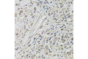 Immunohistochemistry of paraffin-embedded human prostate cancer using SMARCC2 antibody. (SMARCC2 抗体)