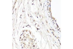 Immunohistochemistry of paraffin-embedded human breast using CDK7 antibody. (CDK7 抗体  (AA 211-346))