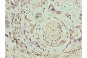 Immunohistochemistry of paraffin-embedded human pancreatic cancer using ABIN7171798 at dilution of 1:100 (SLC26A8 抗体  (AA 414-595))