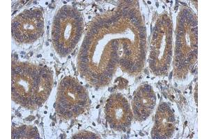IHC-P Image Immunohistochemical analysis of paraffin-embedded human colon carcinoma, using DNAJB12, antibody at 1:500 dilution. (DNAJB12 抗体  (Center))