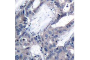 Immunohistochemistry of paraffin-embedded human breast carcinoma using Phospho-MAP2K2-T394 antibody (ABIN2987359). (MEK2 抗体  (pThr394))