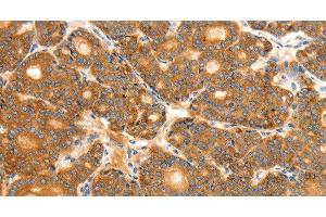 Immunohistochemistry of paraffin-embedded Human thyroid cancer tissue using SCT Polyclonal Antibody at dilution 1:40 (Secretin 抗体)