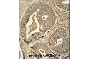 ISCA2 antibody (Center) (ABIN654448 and ABIN2844182) immunohistochemistry analysis in formalin fixed and paraffin embedded human prostate carcinoma followed by peroxidase conjugation of the secondary antibody and DAB staining. (ISCA2 抗体  (AA 72-101))