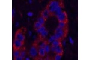 Immunofluorescence analysis of Human liver cancer tissue using NFKBIB Monoclonal Antibody at dilution of 1:200. (NFKBIB 抗体)