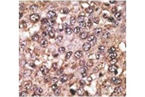IHC analysis of FFPE human hepatocarcinoma tissue stained with the SIRT5 antibody (SIRT5 抗体  (AA 263-292))
