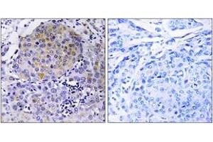Immunohistochemistry analysis of paraffin-embedded human breast carcinoma tissue, using CEP78 Antibody. (CEP78 抗体  (AA 301-350))