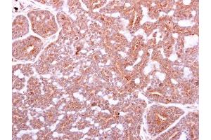 IHC-P Image IGF1 antibody detects IGF1 protein at cytoplasm on human breast carcinoma by immunohistochemical analysis.