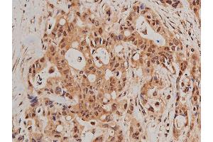 ABIN6267627 at 1/200 staining human colon cancer tissue sections by IHC-P.