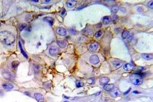 Immunohistochemistry (IHC) analyzes of p-EGFR antibody in paraffin-embedded human breast carcinoma tissue. (EGFR 抗体  (pTyr1197))