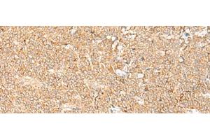 Immunohistochemistry of paraffin-embedded Human ovarian cancer tissue using LGALSL Polyclonal Antibody at dilution of 1:70(x200) (GRP 抗体)