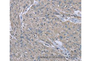 Immunohistochemistry of Human esophagus cancer using EZR Polyclonal Antibody at dilution of 1:30 (Ezrin 抗体)