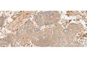 Immunohistochemistry of paraffin-embedded Human esophagus cancer tissue using FBXW8 Polyclonal Antibody at dilution of 1:65(x200) (FBXW8 抗体)