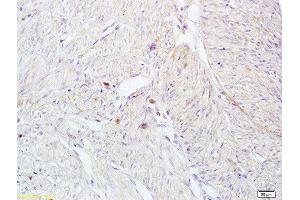 Formalin-fixed and paraffin embedded human breast carcinoma tissue labeled with Anti-CD161 Polyclonal Antibody, Unconjugated at 1:200 followed by conjugation to the secondary antibody and DAB staining (CD161 抗体  (AA 151-225))