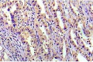 Immunohistochemistry (IHC) analyzes of p-HER2 antibody in paraffin-embedded human lung adenocarcinoma tissue. (PRKAB1 抗体)