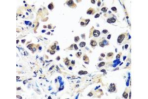 Immunohistochemistry of paraffin-embedded Human lung cancer using CAND1 Polyclonal Antibody at dilution of 1:100 (40x lens). (CAND1 抗体)